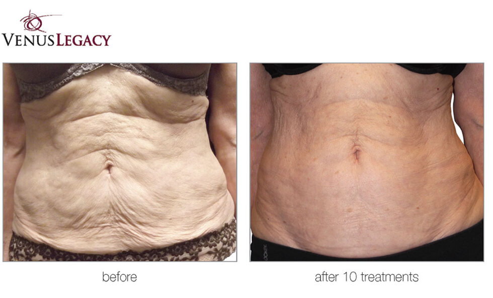 Venus Legacy Body Contouring AgeLess SPAS