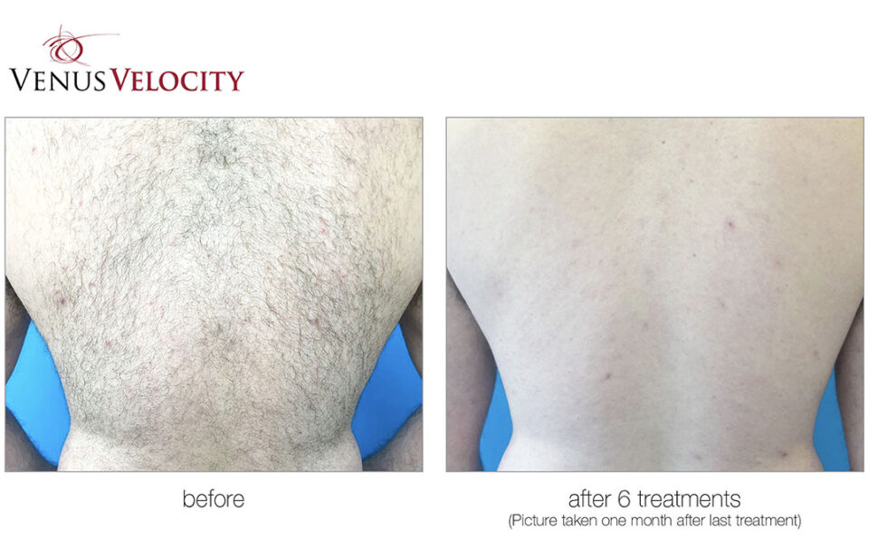 Laser Hair Removal Corning NY AgeLess SPAS