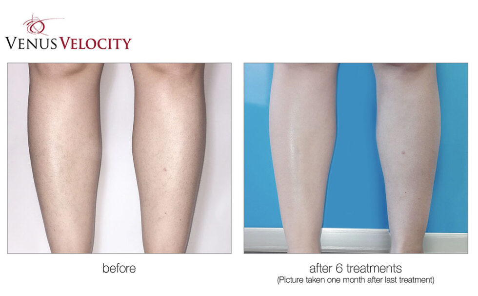 Laser Hair Removal Corning NY AgeLess SPAS